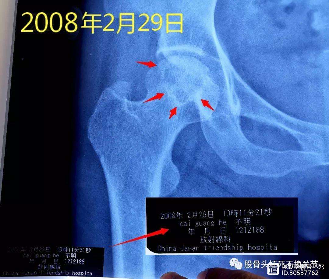 呼和浩特人工骨头医保报销多少(人工骨头医保报销多少比例)