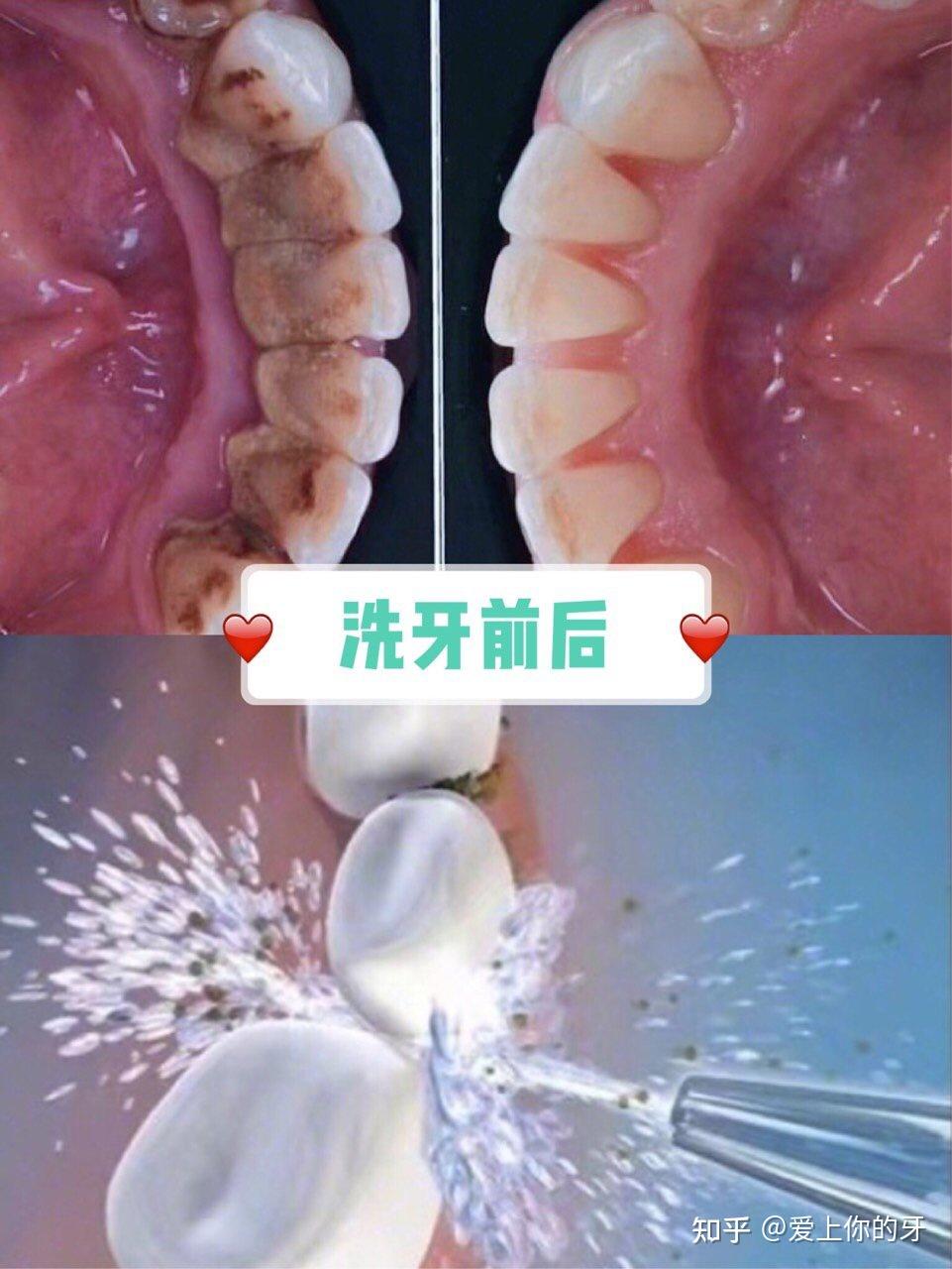 呼和浩特洗牙可以用医保吗(洗牙可以用医保吗,报销比例多少)